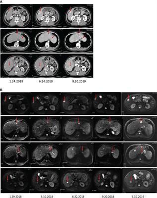 Transcatheter arterial chemoembolization of apatinib and camrelizumab (SHR1210) against liver metastasis from hepatic neuroendocrine tumor: a case report